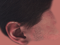 skin3