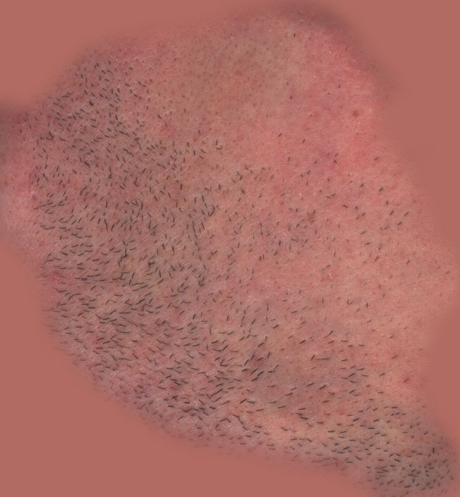 skin4